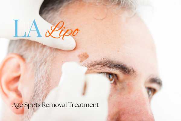 What Are the Most Effective Treatments for Age Spots Gerrards Cross?