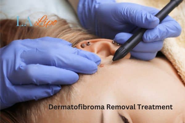 Dermatofibroma Removal Treatment Gerrards Cross