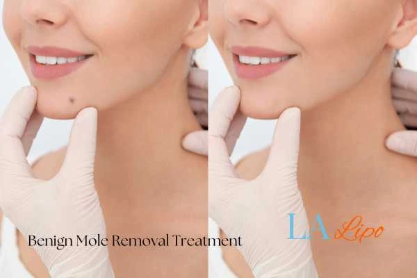 woman's before and after mole removal Gerrards Cross results