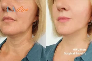 hi-fu for wrinkles Gerrards Cross before and after results