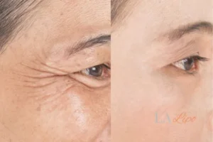 Before and after results of woman - HI-fu wrinkles reduction treatment Gerrards Cross
