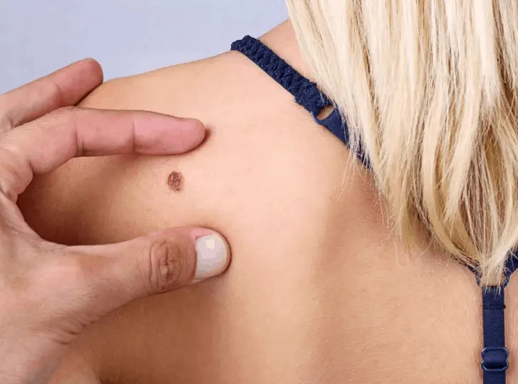 woman having mole removal Gerrards Cross consultation before treatment.