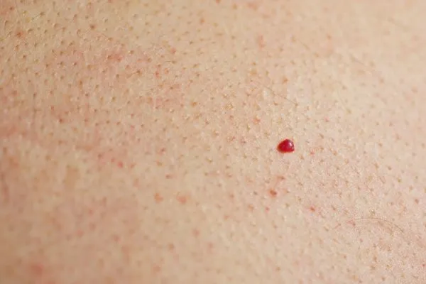 close up of a cherry angioma Gerrards Cross