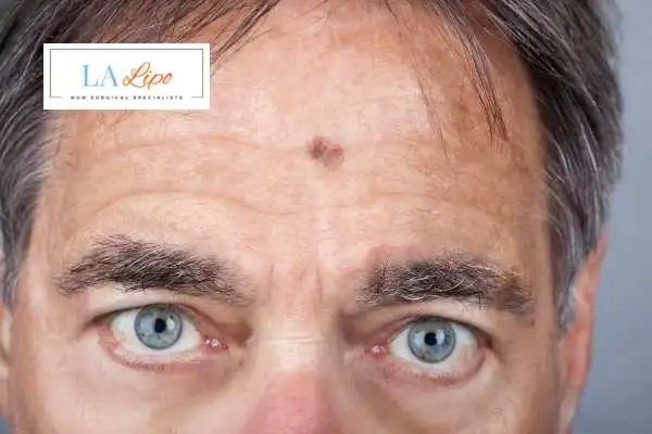 Solar Lentigo Removal Gerrards Cross image of man with mark on his forehead