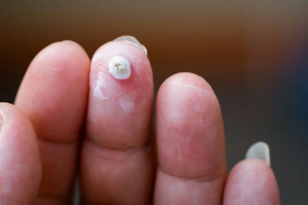 wart on person finger - cryotherapy to treat from LA LIPO Gerrards Cross