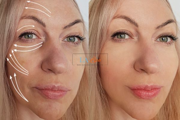 Morpheus 8 results Gerrards Cross face lift.