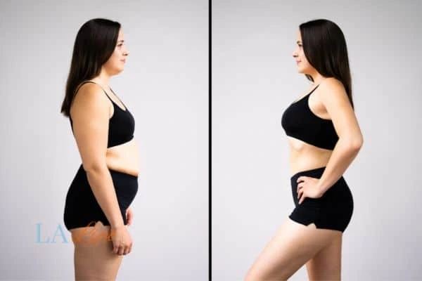 Picture of womans before and after using LA-EMS body sculpting to improve her core strength Gerrards Cross