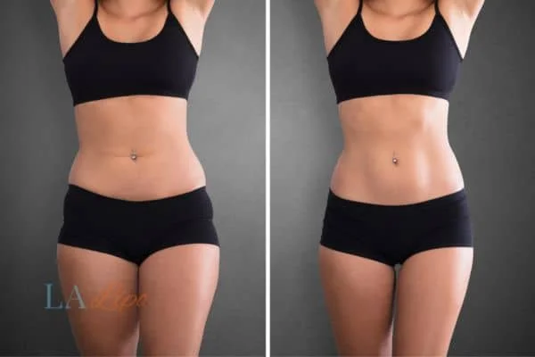 before and after results of non-surgical treatment to help a woman's body image and mental health Gerrards Cross