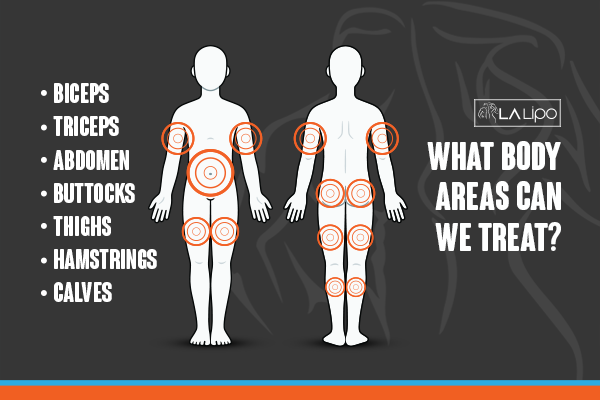 Diagram to show areas you can have LA-EMS Body Sculpting Treatment Gerrards Cross