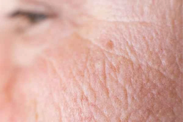 close up picture of a woman's face showing an age spot Gerrards Cross