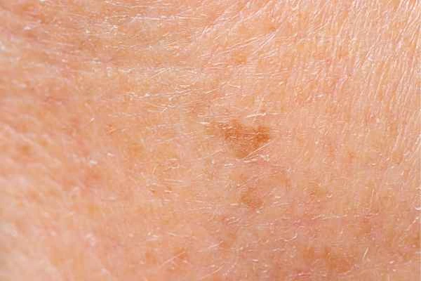close up picture of age spots Gerrards Cross