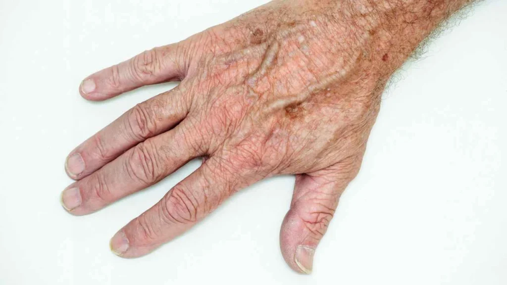 Male hand showing age spot Gerrards Cross
