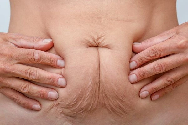 Should I Combine Diastasis Recti Treatment with Body Contouring for Better Results Gerrards Cross?