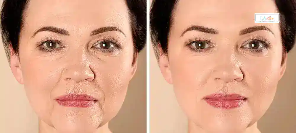 How Long Does It Take to See Results and How Long Do They Last Gerrards Cross?