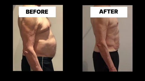 What Symptoms Can Diastasis Recti Cause in Men? Weak Core, Back Pain and Poor Posture Gerrards Cross